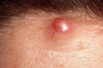 آبسه چند نوع است ؟ چگونه تشخیص و درمان میشود ؟