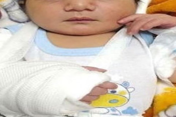 تولد نوزاد خرمشهری با دست شکسته!