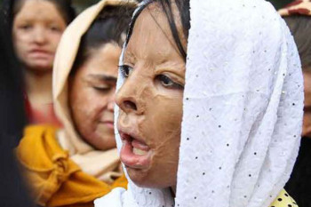 چهره دختران شین آباد بعد از 9 سال / دختران بیگناهی که صورتشان در آتش سوخت!