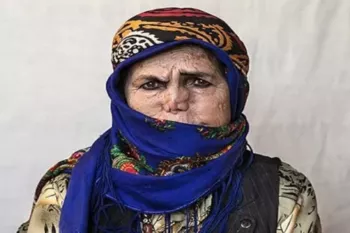 شیوع «جذام» در ایران صحت دارد؟