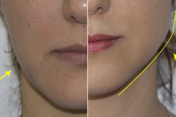 زاویه سازی صورت با استفاده از تزریق ژل به فک