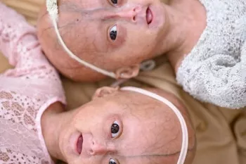 با دوقلوهای مبتلا به سندرم نادر بنجامین باتن آشنا شوید !