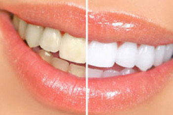 چگونه در خانه دندان های خود را سفید کنیم؟
