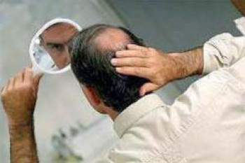 ژنتیک شایع ترین علت ریزش موی سر آقایان
