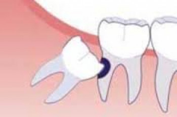 در مورد دندان نهفته چه میدانید؟