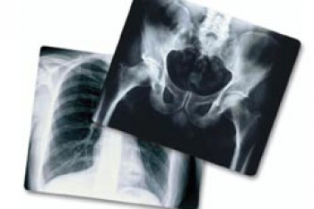 اشعه ایکس چیست و از اشعه ایکس کجا استفاده می شود