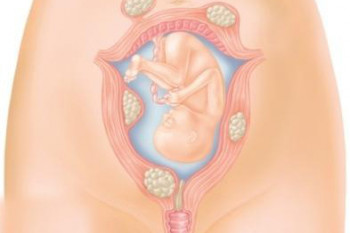 فیبروم رحم در بارداری چیست