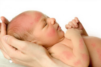 بیماری پوستی کودکان،آشنایی شما علائم بیماری های پوستی کودکتان چقدر است؟