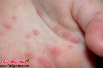 كهير و دلیل پزشکی آن