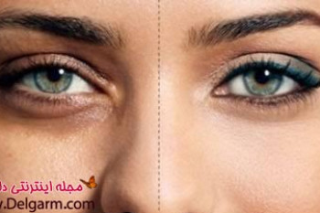سیاهی دور چشم و درمان اصلی آن