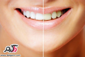 روش هایی برای سفید شدن دندان