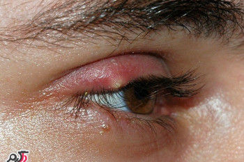 گل مژه(Hordeolum) چیست؟ راه های درمان گل مژه روی پلک چیست؟