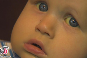 زردی نوزادان در بدو تولد + درمان خانگی