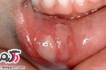 درمان آفت دهان به روش طب سنتی