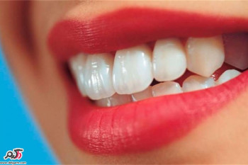 چگونه دندان های سفید و درخشانی داشته باشیم؟