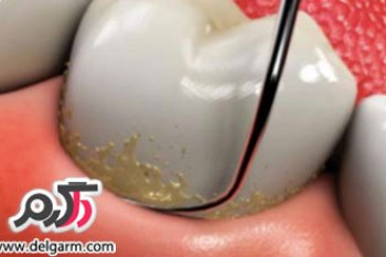 چگونه جرم های دندان را به آسانی از بین ببریم؟