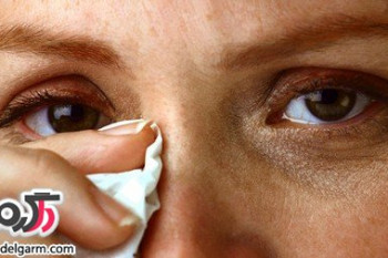 عفونت چشم به همراه درمان خانگی