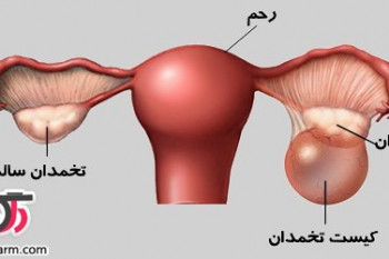 علت و درمان کیست در تخمدان