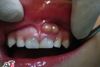 علت آبسه دندان + درمان