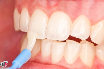 فواید فلوراید بر سلامت دندان