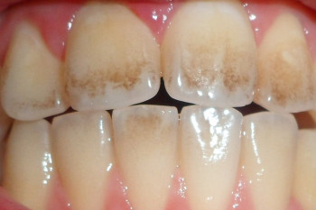 عواملی که باعث خرابی دندان ها میشود