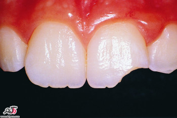 علت شکستن دندان بطور ناگهانی چیست؟