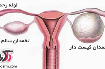 کیست های تخمدان را بشناسید(خانم ها بخوانید و بدانید)