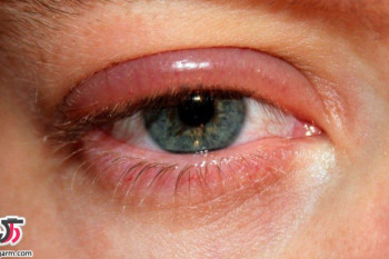 درمان شالازیون چشم به روش طب سنتی