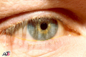 بلفاریت چشم و بهترین راه درمان بلفاریت چشم