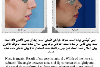 گالری از (رینوپلاستی) جراحی زیبایی بینی دکتر حمیدرضا حسنانی 