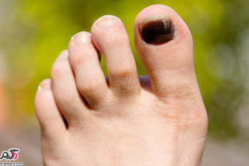 علت سیاه شدن ناخن پا چیست؟