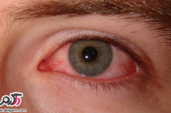 علت ایجاد لکه قرمز در چشم چیست؟