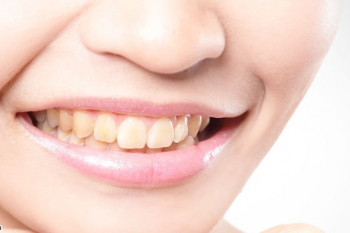علت ایجاد لکه قهوه ای و زرد روی دندانها چیست؟