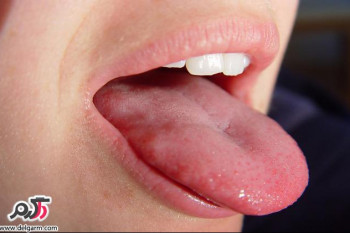مضرات رعایت نکردن بهداشت زبان و دهان
