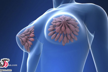 علت سرطان سینه و درمان سرطان پستان(Breast Cancer)