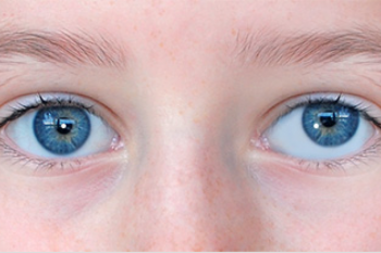 درمان انحراف چشم (لوچی یا استرابیسم)