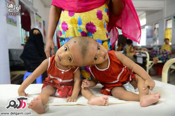  رابعه و روکیا بنگلادشی دو نوزاد به هم چسبیده