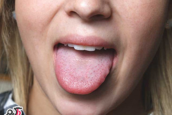 علت وجود لکه های سفید روی زبان چیست؟