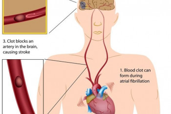 علائم و علت عارضه فیبریلاسیون دهلیزی (AF قلب )چیست؟