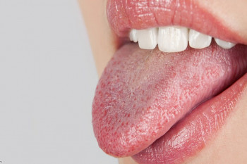 دلایل خشک شدن دهان چیست؟