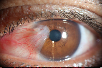 علت لکه سفید روی چشم چیست؟