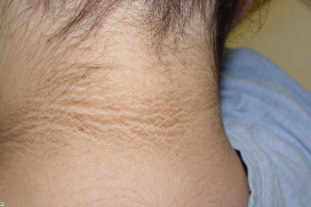 علت و درمان بیماری پوستی آکانتوزیس نیگریکانس