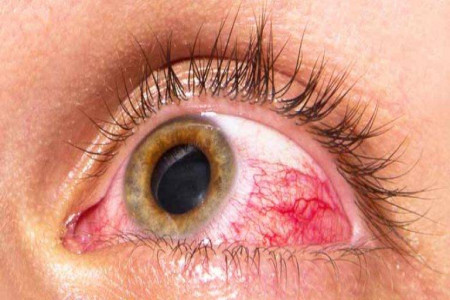 عامل ورم ملتحمه چشم چیست؟