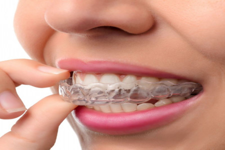 همه چیز درباره ارتودنسی نامرئی