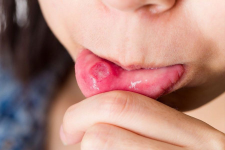همه چیز درباره بیماری بهجت یا جاده ابریشم از علل تا علائم و تشخیص