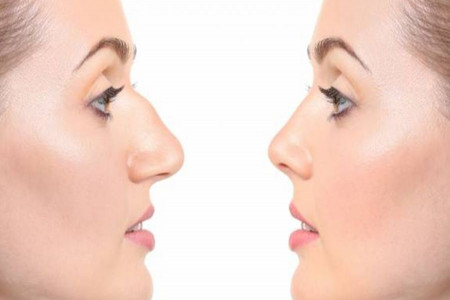 پاسخ به سوالات رایج درباره عمل بینی