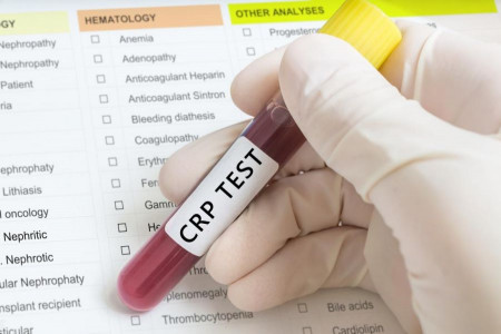 علت بالا و پایین بودن CRP در آزمایش خون
