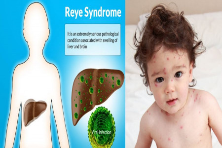 بیماری خطرناک سندرم ری و دلایل ابتلا به این بیماری