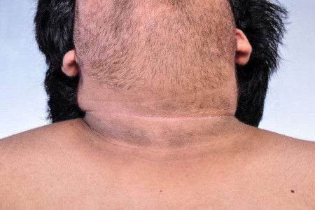 تیرگی گردن : 11 درمان خانگی برای رفع تیرگی گردن