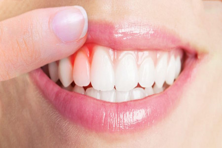 سوزش لثه نشانه چیست و چگونه درمان میشود ؟